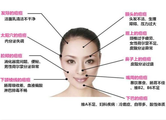 原來這些因素會導致長痘痘！你知道嗎?